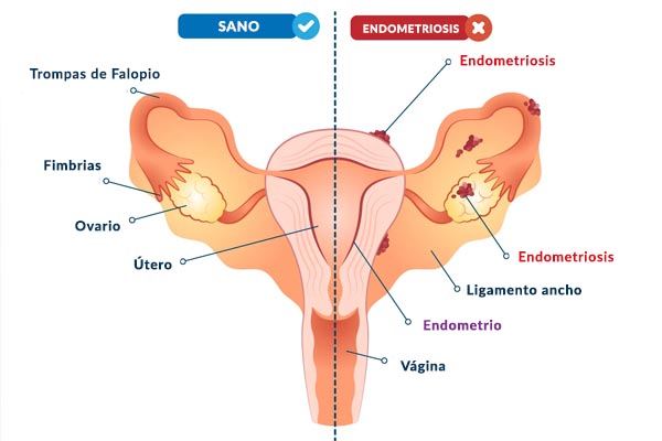 endometriosis-causas-sintomas-tratamiento3